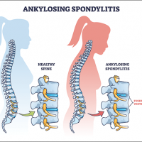 Ankylosing Spondylitis Symptoms